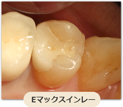 Eマックスインレー