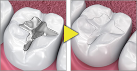 金属アレルギー・虫歯再発リスクの心配がない